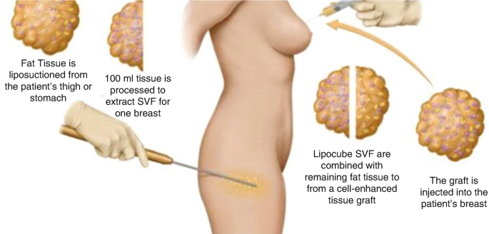 Stem Cell-Enriched Fat Injection in Aesthetic, Reconstructive Breast  Surgery