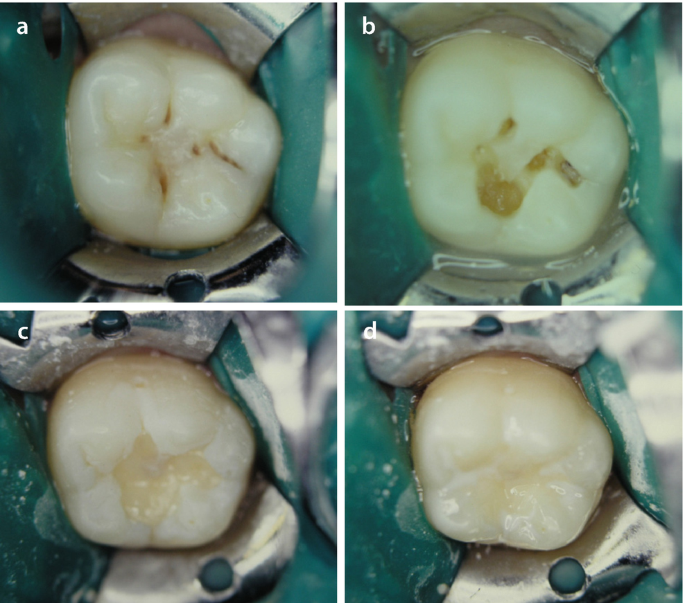 Restoration of Carious Hard Dental Tissues | SpringerLink