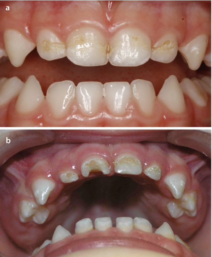 Nu Dentistry  Tooth Contouring: A Quick and Painless Procedure