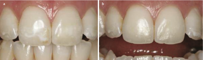 Developmental Defects of the Teeth and Their Hard Tissues | SpringerLink