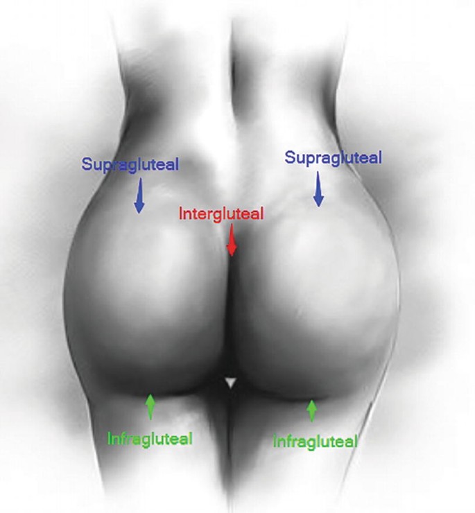 St Louis Flank and Hip Liposuction Procedure