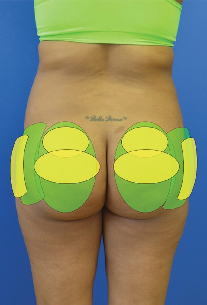 Suction-Assisted Lipectomy and Brazilian Butt Lift