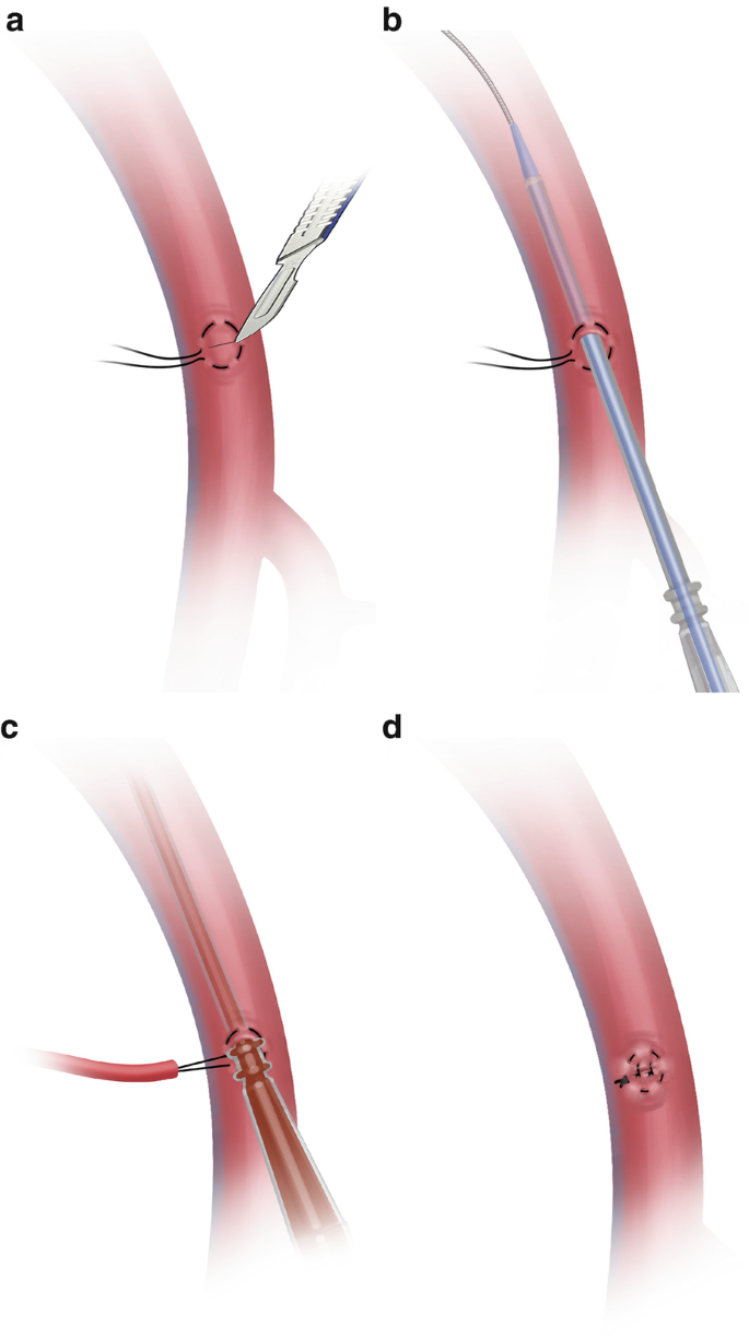 Double purse-string around the inner cuff of the peritoneal catheter: A  novel technique for an immediate initiation of continuous peritoneal  dialysis - Antonio Scalamogna, Luca Nardelli, Francesca Zanoni, Piergiorgio  Messa, 2020