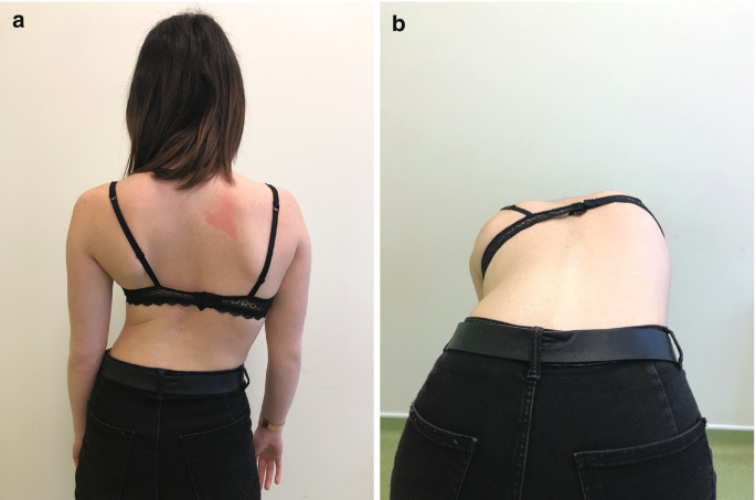 Idiopathic Scoliosis | SpringerLink