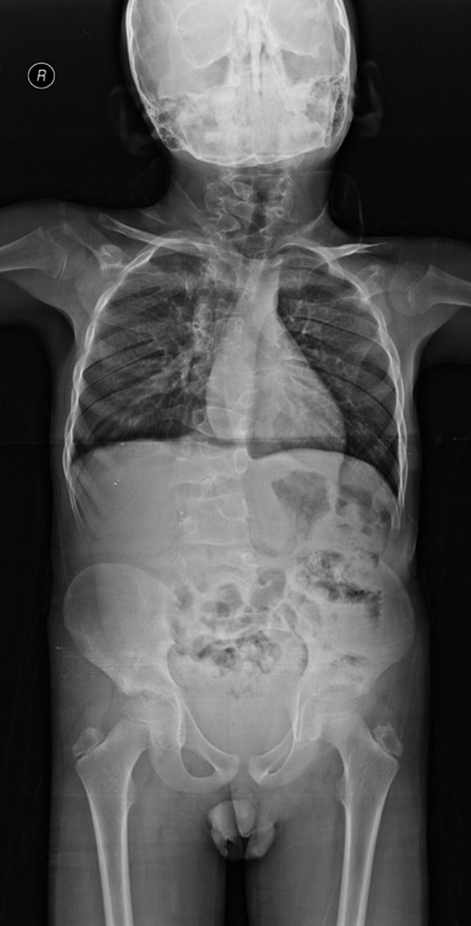 Klippel-Feil Syndrome | Springer Nature Link (formerly SpringerLink), image size:661x1299