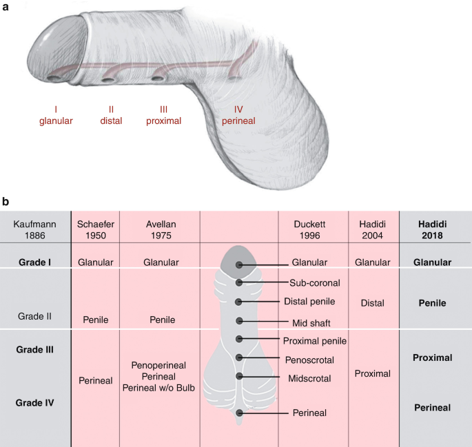 Hidden penile ring constriction in a non‐erectile state. The folds of