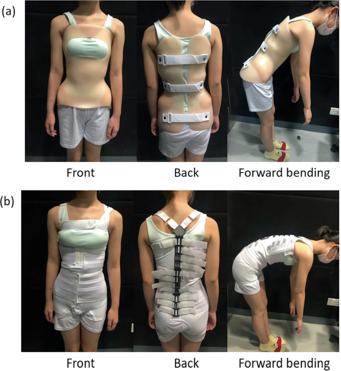 A Case Study of Initial In-Brace Spinal Correction of Anisotropic