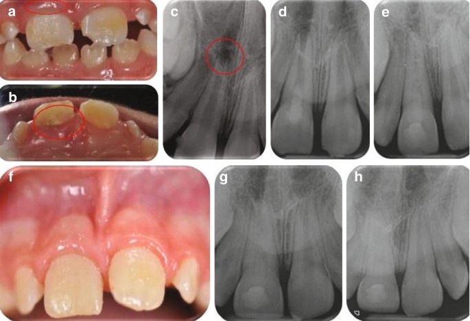 BiodentineTM Applications in Traumatology and Fractures