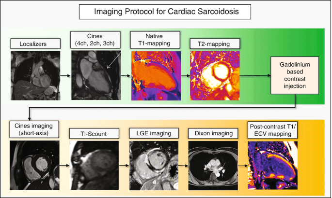Cardiac Sarcoidosis Springerlink