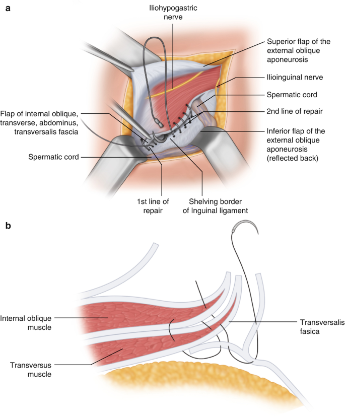 Shouldice Repair of Inguinal Hernia | SpringerLink