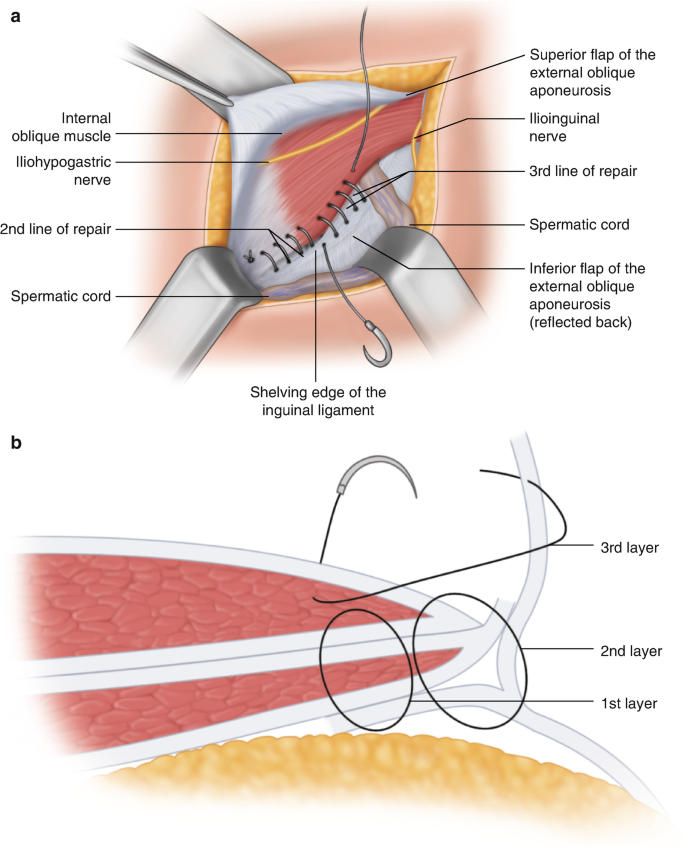 Shouldice Repair of Inguinal Hernia | SpringerLink
