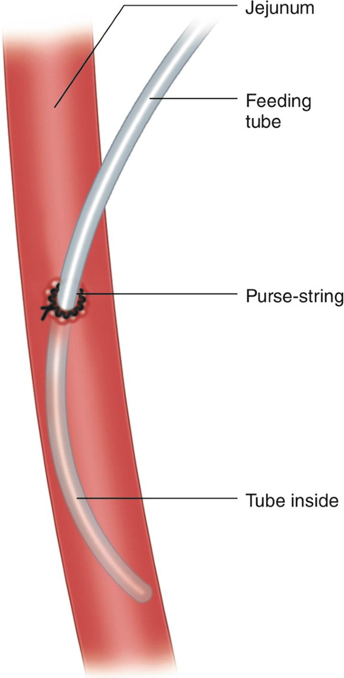 Double purse-string duct-to-mucosa – The Pancreatic Anastomosis