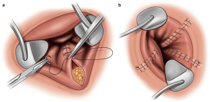 Excisional Hemorrhoidectomy (Ferguson, Milligan-Morgan, Whitehead) |  SpringerLink