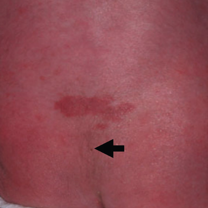 Dermal Sinus Tract and Tethered Cord Syndrome | SpringerLink