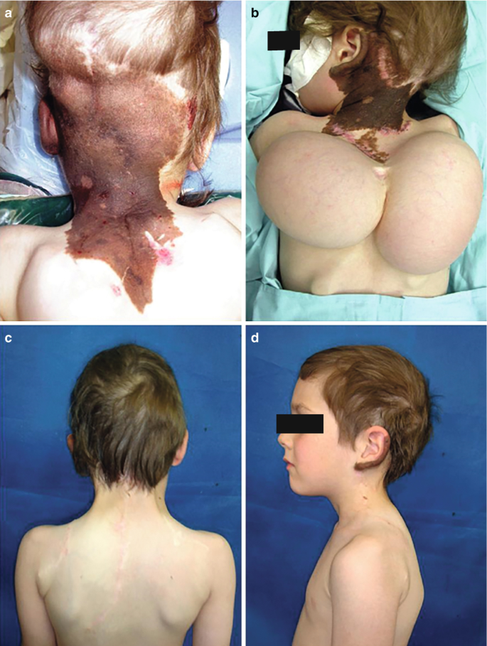 Four close-ups of a boy undergoing treatment for a large congenital melanocytic nevus in his posterior neck that extends to his upper back and occipital scalp.