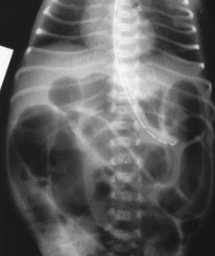 An anterior view X-ray of a newborn's abdominal with distal minor bowel stenosis.