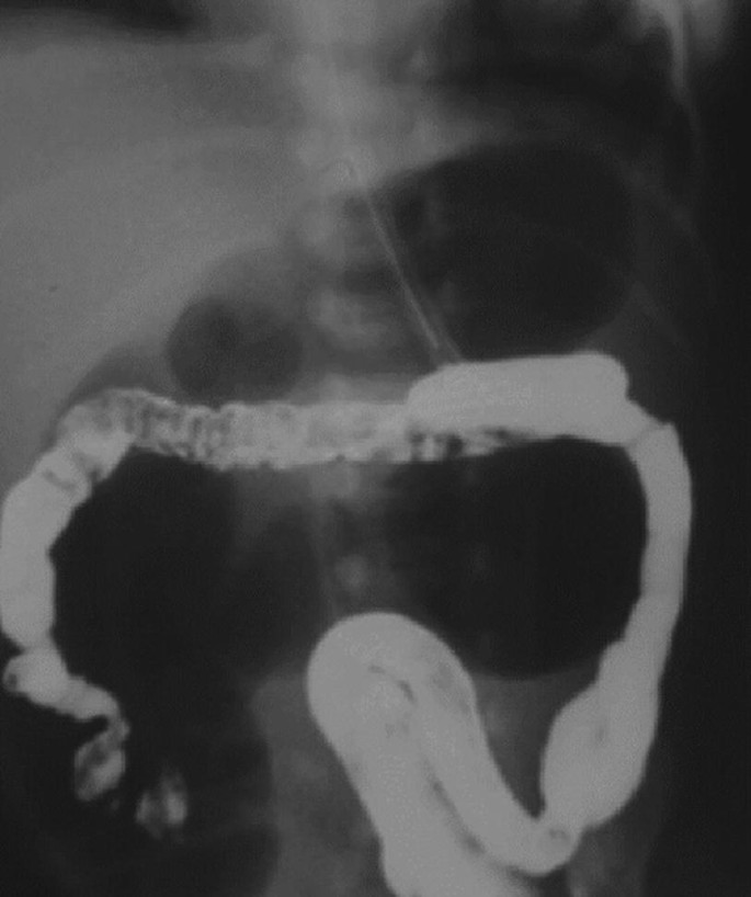 An anterior view X-ray of a newborn's abdominal with highlighted dilated small bowel loops.