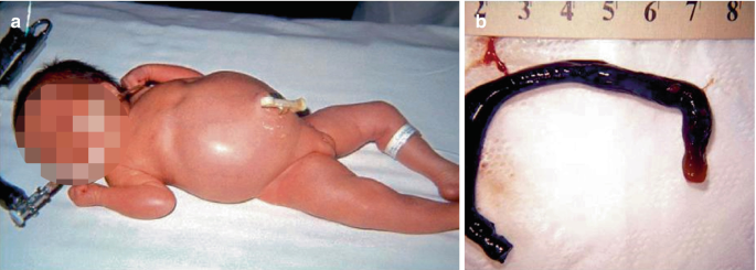 2 photographs illustrate a newborn with a bulging stomach and a large meconium plug.