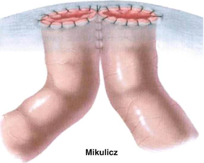 An illustration of the Mikulicz ileostomy with two openings from the intestine appears as if brought to the skin's surface and stitched.