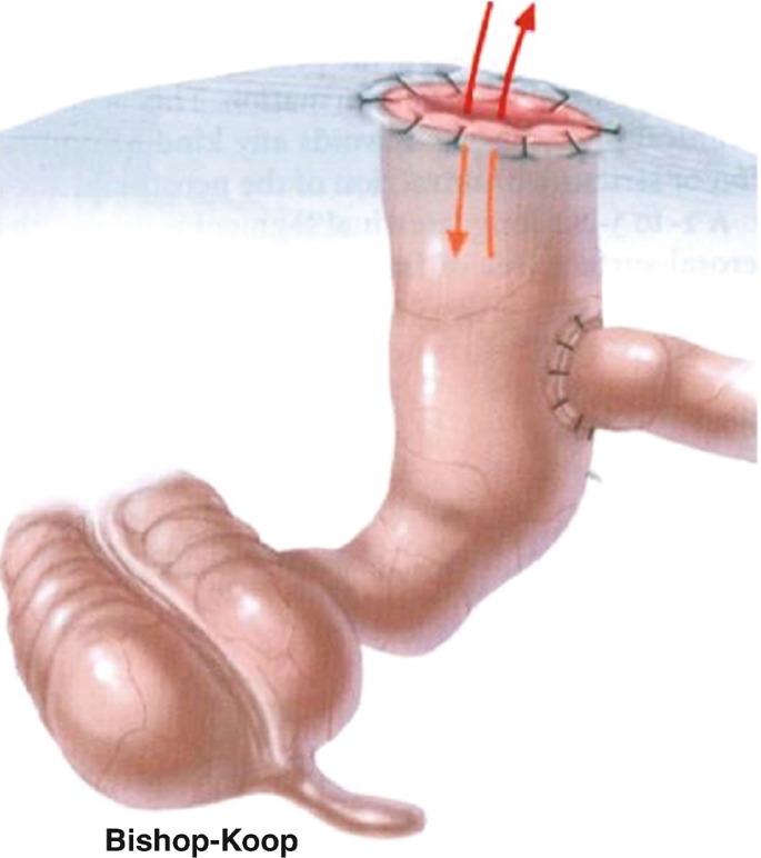 An illustration of the Bishop-Koop ileostomy with one opening from the intestine appears attached to the skin's surface with stitches.