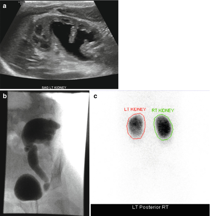 Partners in Care  Fetal hydronephrosis is treated in the…