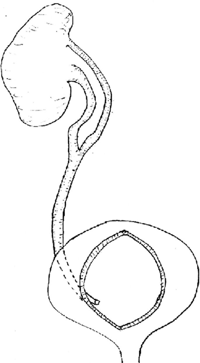 A drawing of the incomplete duplication of the ureters. Two ureters from a kidney join and then open into the urinary bladder as a single ureter.