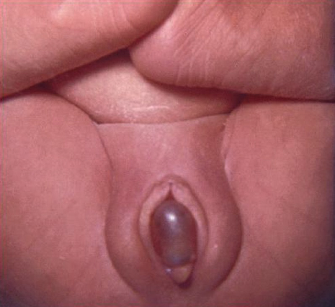 A photograph. A close-up view of a translucent balloon-like ureterocoele in the urethral opening of a baby.