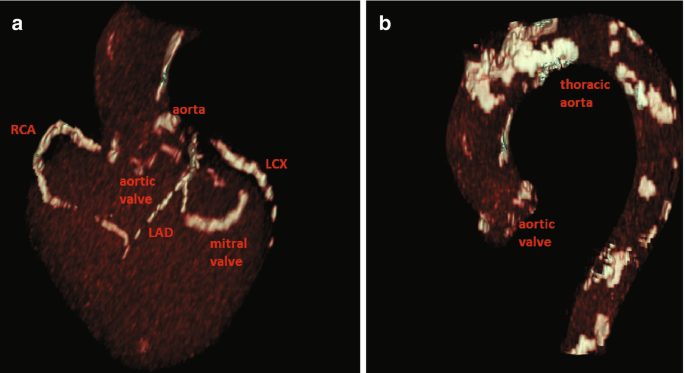 Two epidemiology illustrations. The first is marked R C A, aorta, aortic valve, L C X, L A D, and mitral value, while the second is categorized as the thoracic aorta and aortic valve.