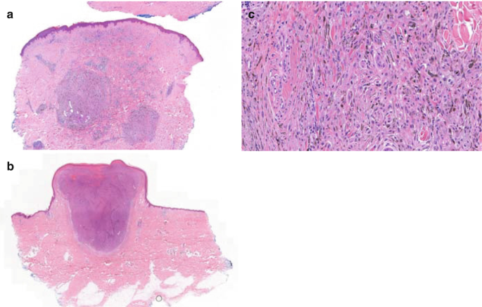 The Histopathology of Melanocytic Nevi and Malignant Melanoma