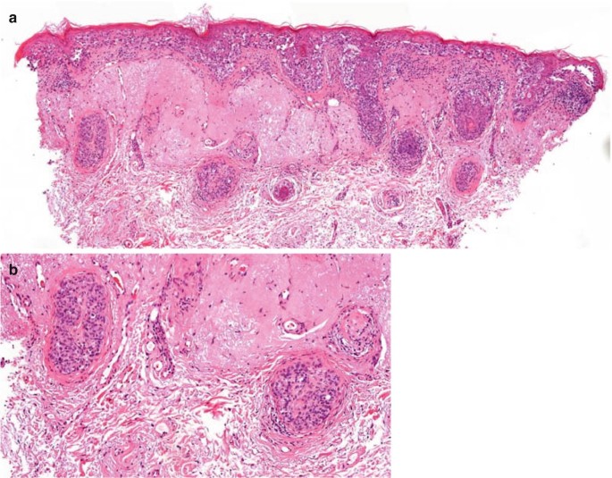 The Histopathology of Melanocytic Nevi and Malignant Melanoma | Springer  Nature Link