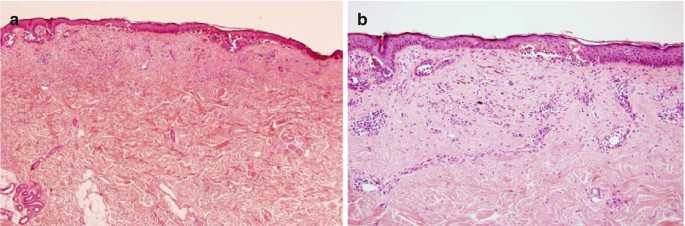 The Histopathology of Melanocytic Nevi and Malignant Melanoma | Springer  Nature Link