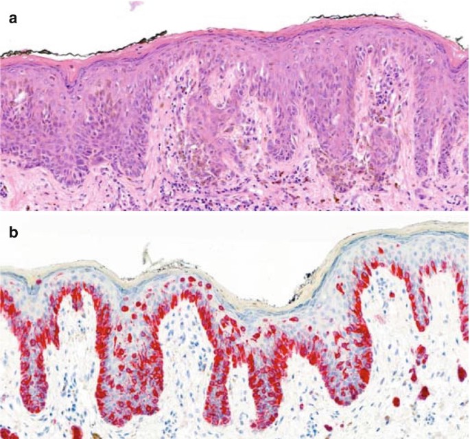 The Histopathology of Melanocytic Nevi and Malignant Melanoma