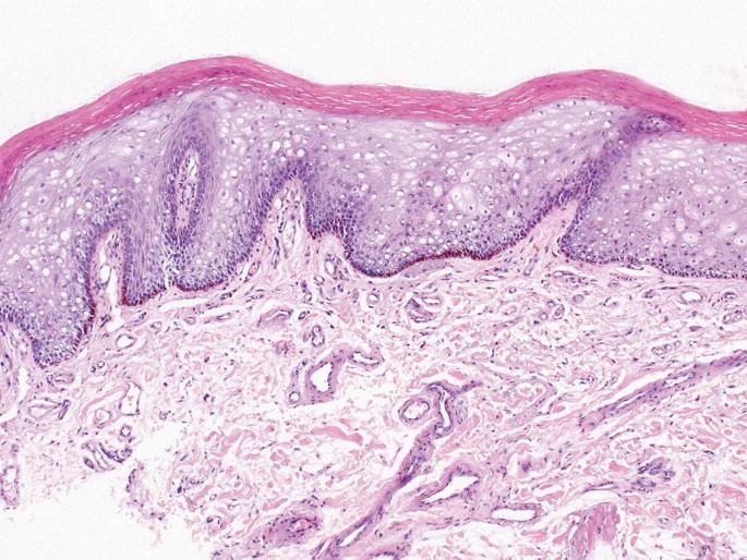 oral melanotic macule histology Pigmented Lesions of the Oral Mucosa main image 0