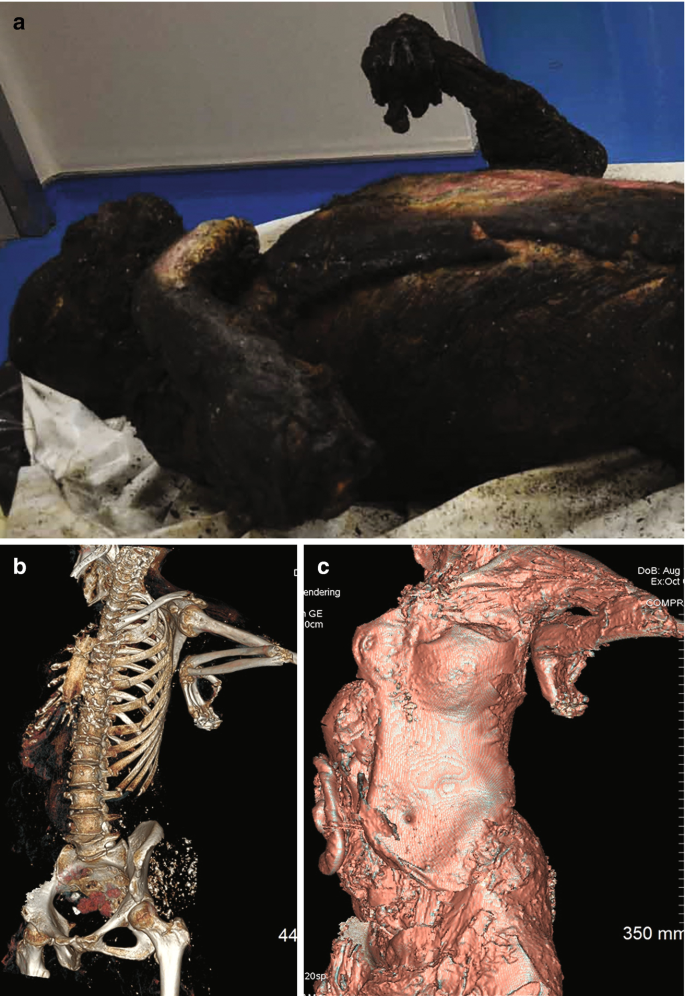 Post-mortem Computed Tomography of Charred Victims in Modern Forensic  Medicine | SpringerLink