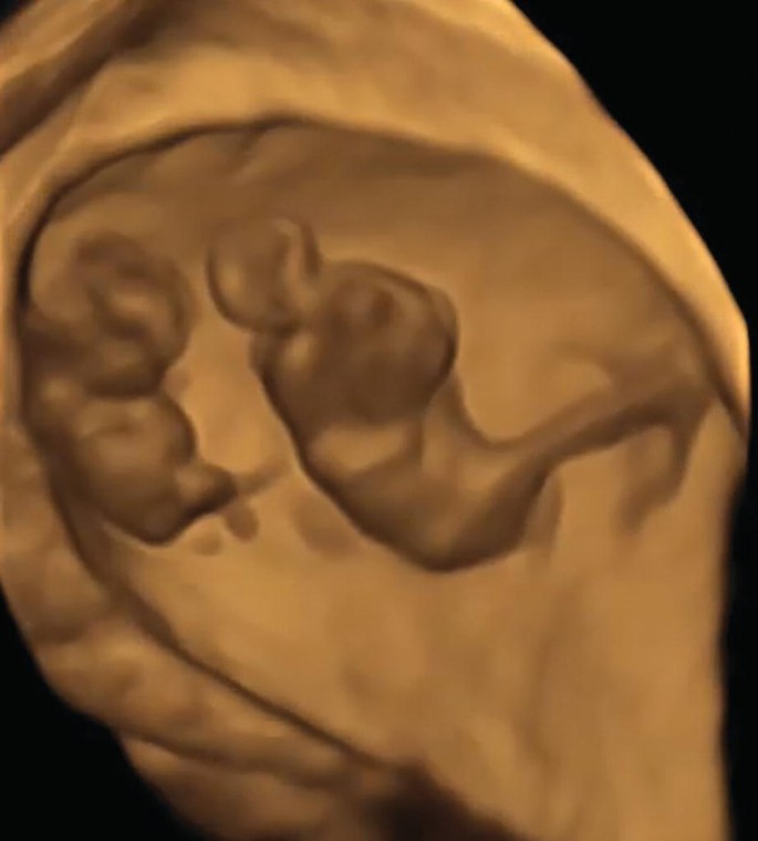 Clinical Use Of 3d Sonography Springerlink