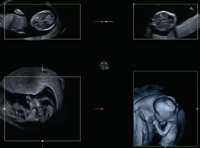 Clinical Use Of 3d Sonography Springerlink