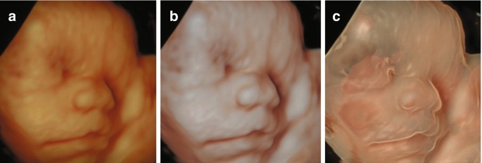 Clinical Use Of 3d Sonography Springerlink