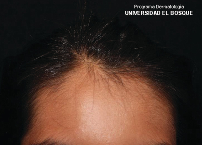 Inflammatory Diseases of the Hair Follicle | SpringerLink