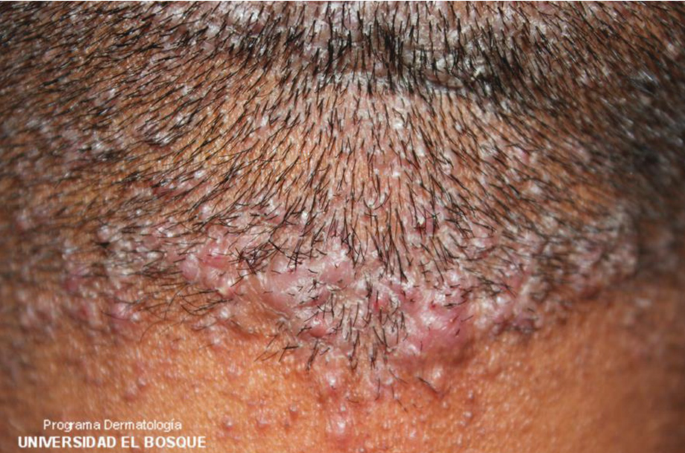 Inflammation of hair follicles  WikiLectures