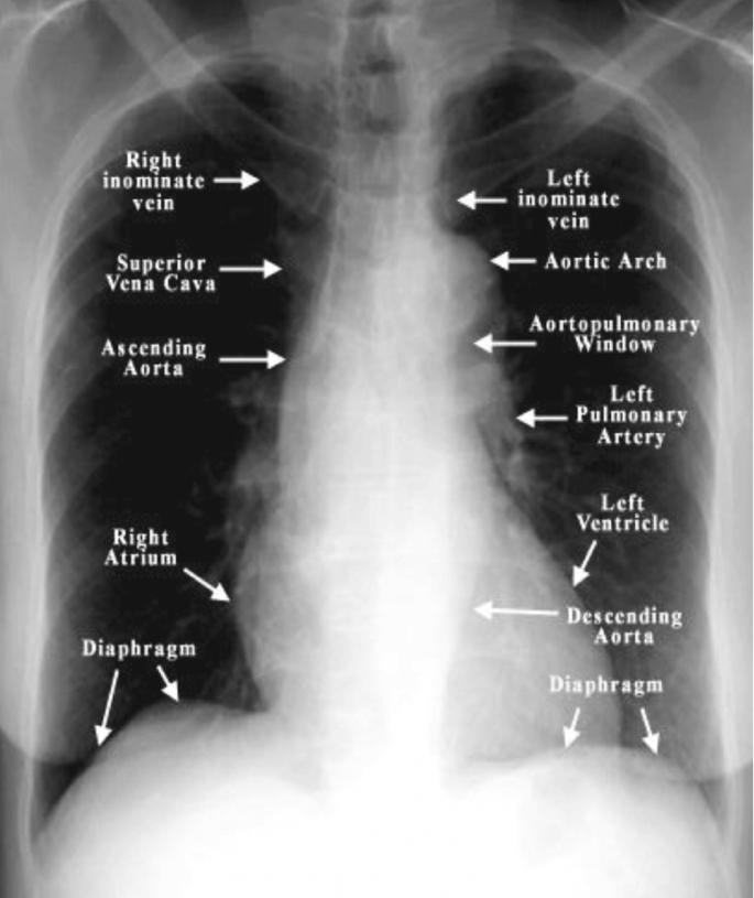 Chest X-Ray and Chest CT | SpringerLink