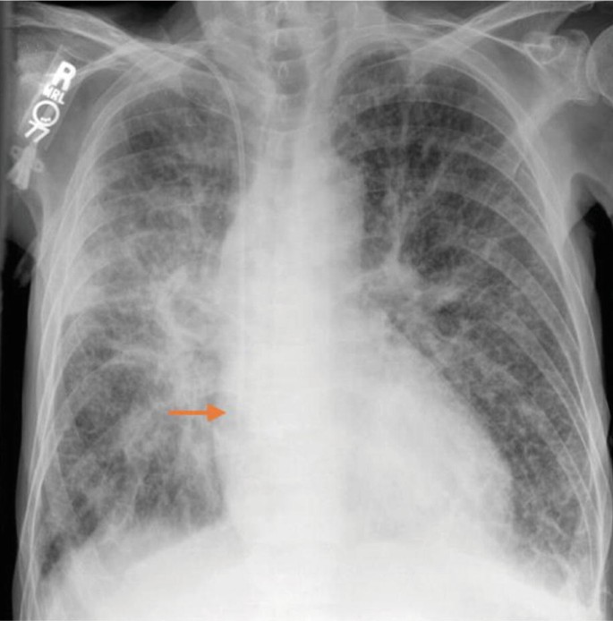 chest x ray double pneumonia
