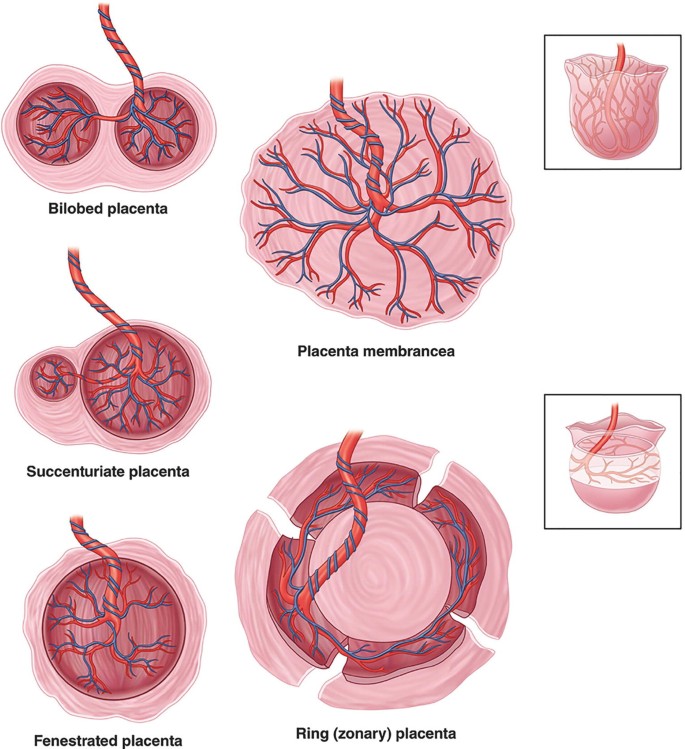 Placental Shape Aberrations | SpringerLink