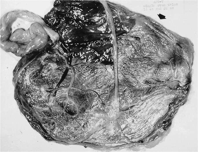 placenta fenestrata