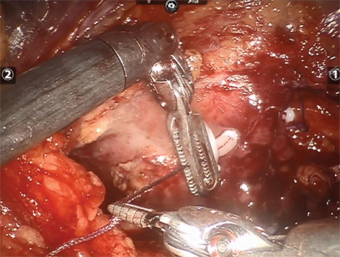 Transperitoneal and Retroperitoneal Port Placement