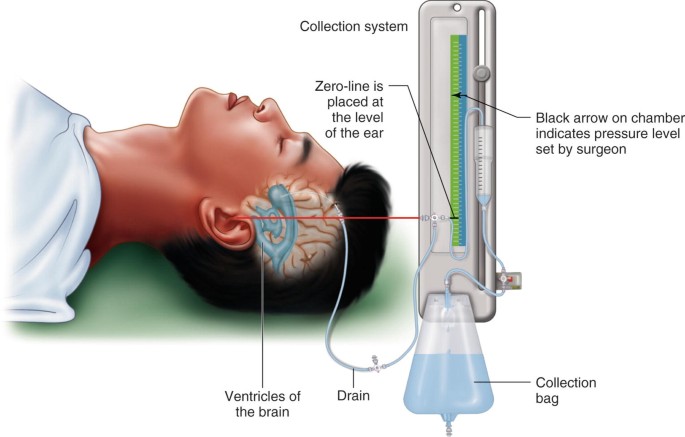 What Is Endoscopic Third Ventriculostomy ?