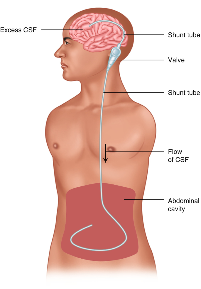 Ventriculoperitoneal Shunt Tap