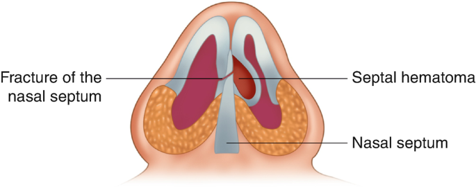 nasal septal hematoma