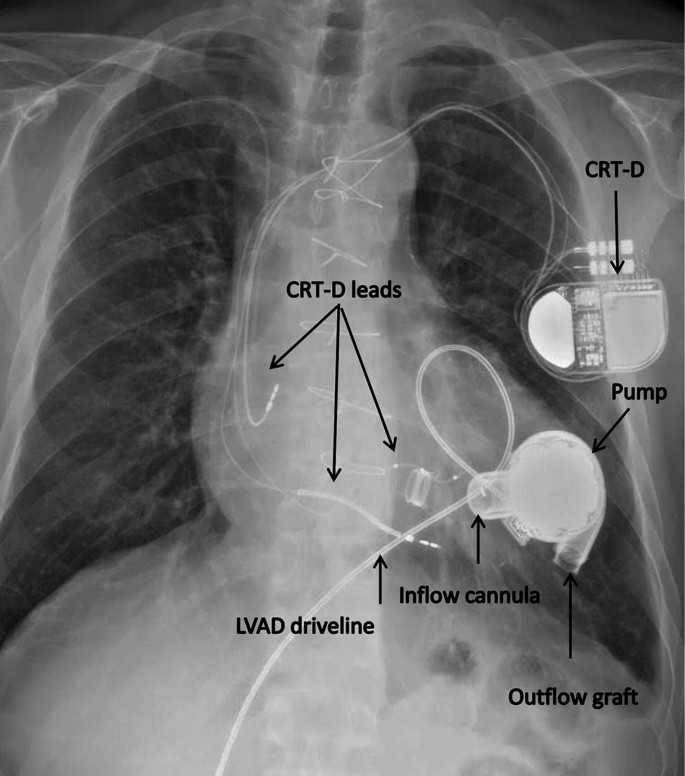 Acute Middle Cerebral Artery Occlusion in a Heart Transplant 