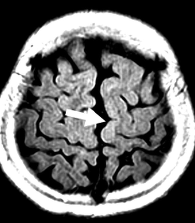 Focal Cortical Dysplasia, Type IIa | SpringerLink