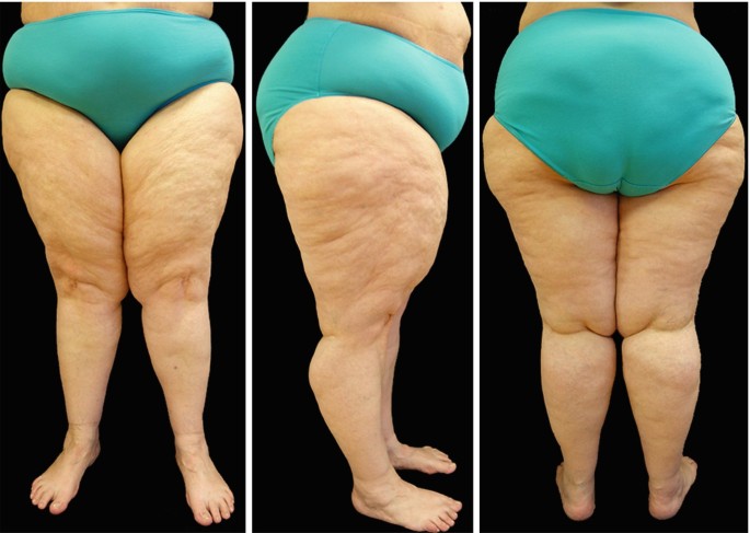 Example of clinical images of patients with lipedema (top) and